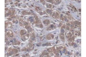 DAB staining on IHC-P; Samples: Human Breast cancer Tissue (GBP4 Antikörper  (AA 1-292))