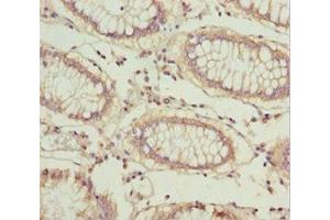 Immunohistochemistry of paraffin-embedded human colon cancer using ABIN7164553 at dilution of 1:100 (LARS2 Antikörper  (AA 1-250))