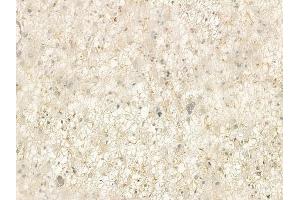 ABIN6264975 and ABIN6278524 at 1/100 staining human astrocytoma by IHC-P.