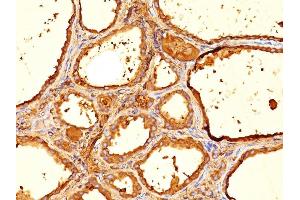 Formalin-fixed, paraffin-embedded human Thyroid stained with Thyroglobulin Mouse Monoclonal Antibody (6E1).