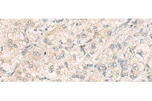 Immunohistochemistry of paraffin-embedded Human liver cancer tissue using THG1L Polyclonal Antibody at dilution of 1:70(x200) (THG1L Antikörper)
