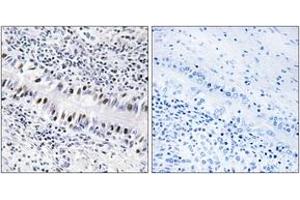 Immunohistochemistry analysis of paraffin-embedded human lung carcinoma, using ZNF76 Antibody. (ZNF76 Antikörper  (AA 116-165))