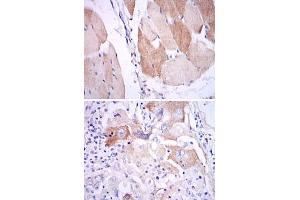 Immunohistochemical analysis of paraffin-embedded human muscle (upper) and human lung cancer (bottom) tissues using IL1B monoclonal antibody, clone 3A6  with DAB staining. (IL-1 beta Antikörper)