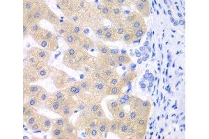 Immunohistochemistry of paraffin-embedded Human liver cancer using CYP2C18 Polyclonal Antibody at dilution of 1:100 (40x lens). (CYP2C18 Antikörper)
