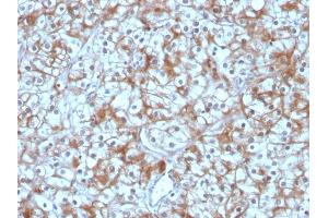 Formalin-fixed, paraffin-embedded human Bladder Carcinoma stained with Calpastatin Mouse Monoclonal Antibody (CAST/1550). (Calpastatin Antikörper)