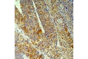Immunohistochemical analysis of Cyclophilin B staining in human heptacancer,human pancreatic cancer formalin fixed paraffin embedded tissue section. (PPIB Antikörper)