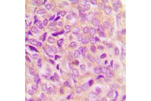 Immunohistochemical analysis of GRP78 staining in human breast cancer formalin fixed paraffin embedded tissue section. (GRP78 Antikörper  (C-Term))