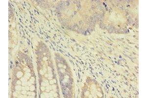 Immunohistochemistry of paraffin-embedded human colon cancer using ABIN7172114 at dilution of 1:100 (TK1 Antikörper  (AA 2-234))