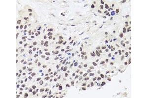 Immunohistochemistry of paraffin-embedded Human lung cancer using RPP30 Polyclonal Antibody at dilution of 1:100 (40x lens). (RPP30 Antikörper)