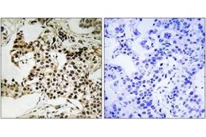 Immunohistochemistry analysis of paraffin-embedded human breast carcinoma, using PKR (Phospho-Thr258) Antibody. (EIF2AK2 Antikörper  (pThr258))