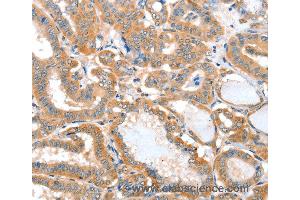 Immunohistochemistry of Human thyroid cancer using ACOT11 Polyclonal Antibody at dilution of 1:25 (ACOT11 Antikörper)