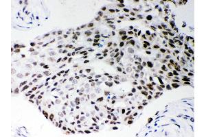 Anti- SF2 Picoband antibody, IHC(P) IHC(P): Human Mammary Cancer Tissue