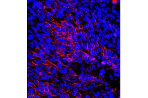 Immunofluorescence of paraffin embedded human ovarian cancer using TFIIIC110 (ABIN7074038) at dilution of 1:650 (400x lens) (GTF3C2 Antikörper)