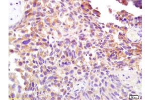 Formalin-fixed and paraffin embedded human bladder carcinoma labeled with Rabbit Anti CD138/Syndecan-1 Polyclonal Antibody, Unconjugated (ABIN674769) at 1:200 followed by conjugation to the secondary antibody and DAB staining (Syndecan 1 Antikörper  (AA 201-310))
