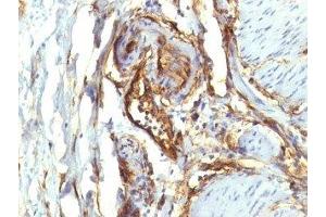 Formalin-fixed, paraffin-embedded human colon carcinoma stained with CD34 antibody (QBEnd/10 + HPCA1/763) (CD34 Antikörper)