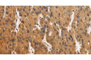 Immunohistochemistry of paraffin-embedded Human liver cancer using CALU Polyclonal Antibody at dilution of 1:40