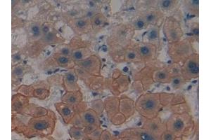 Detection of CK4 in Human Liver cancer Tissue using Polyclonal Antibody to Cytokeratin 4 (CK4) (KRT4 Antikörper  (AA 152-457))