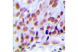 Immunohistochemical analysis of hNRNP C (pS260) staining in human breast cancer formalin fixed paraffin embedded tissue section. (HNRNPC Antikörper  (C-Term, pSer260))