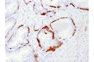Formalin-fixed, paraffin-embedded human Prostate Carcinoma stained with Cytokeratin 14 Mouse Monoclonal Antibody (LL002). (KRT14 Antikörper  (C-Term))