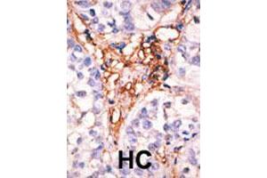 Formalin-fixed and paraffin-embedded human hepatocellular carcinoma tissue reacted with the APOBEC3G polyclonal antibody  , which was peroxidase-conjugated to the secondary antibody, followed by AEC staining. (APOBEC3G Antikörper  (Internal Region))
