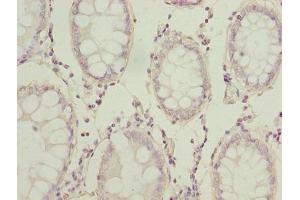 Immunohistochemistry of paraffin-embedded human colon cancer using ABIN7143865 at dilution of 1:100 (ENO1 Antikörper  (AA 2-428))