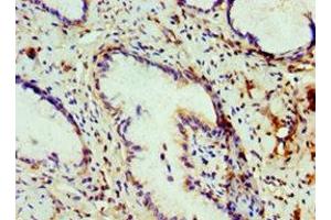 Immunohistochemistry of paraffin-embedded human cervical cancer using ABIN7148465 at dilution of 1:100 (COG7 Antikörper  (AA 511-770))