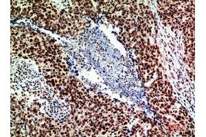 Immunohistochemical analysis of paraffin-embedded human-breast-cancer, antibody was diluted at 1:200 (ACER2 Antikörper  (Internal Region))