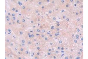 Detection of JAK2 in Human Liver cancer Tissue using Polyclonal Antibody to Janus Kinase 2 (JAK2) (JAK2 Antikörper  (AA 508-800))