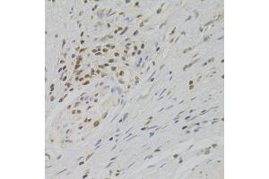 Immunohistochemistry of paraffin-embedded human gastric cancer using TAF1C Antibody. (TAF1C Antikörper  (AA 70-320))