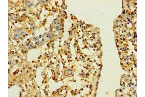 Immunohistochemistry of paraffin-embedded human bladder cancer using ABIN7170195 at dilution of 1:100 (SLC25A4 Antikörper  (AA 40-102))