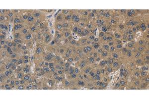 Immunohistochemistry of paraffin-embedded Human liver cancer using EMC8 Polyclonal Antibody at dilution of 1:30 (COX4NB Antikörper)