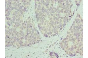 Immunohistochemistry of paraffin-embedded human gastric cancer using ABIN7142845 at dilution of 1:100 (RPL9 Antikörper  (AA 1-192))