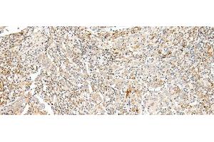 Immunohistochemistry of paraffin-embedded Human cervical cancer tissue using TAAR2 Polyclonal Antibody at dilution of 1:40(x200)