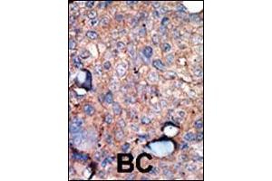 Formalin-fixed and paraffin-embedded human cancer tissue reacted with the primary antibody, which was peroxidase-conjugated to the secondary antibody, followed by AEC staining. (IKKi/IKKe Antikörper  (C-Term))