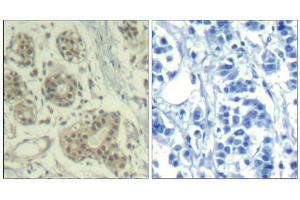 Immunohistochemical analysis of paraffin-embedded human breast carcinoma tissue using MDM2 (phospho-Ser166) Antibody (E011550). (MDM2 Antikörper  (pSer166))