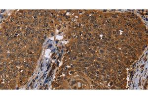 Immunohistochemistry of paraffin-embedded Human cervical cancer using DCP1A Polyclonal Antibody at dilution of 1:50 (DCP1A Antikörper)