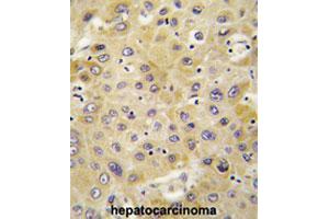 Formalin-fixed and paraffin-embedded human hepatocarcinomareacted with PPBP polyclonal antibody , which was peroxidase-conjugated to the secondary antibody, followed by AEC staining. (CXCL7 Antikörper  (AA 99-128))