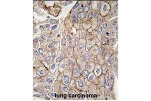 Formalin-fixed and paraffin-embedded human lung carcinoma tissue reacted with CLIC1 antibody, which was peroxidase-conjugated to the secondary antibody, followed by DAB staining.