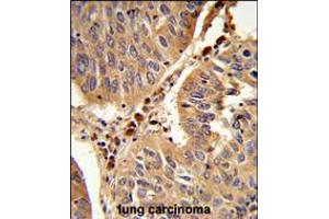 Formalin-fixed and paraffin-embedded human lung carcinoma reacted with PEX16 Antibody , which was peroxidase-conjugated to the secondary antibody, followed by DAB staining. (PEX16 Antikörper  (AA 247-275))