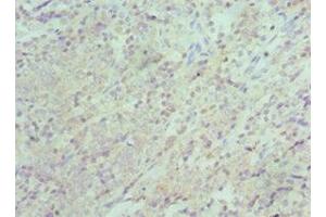 Immunohistochemistry of paraffin-embedded human colon cancer using ABIN7151313 at dilution of 1:100 (XIAP Antikörper  (AA 1-200))