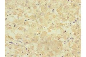 Immunohistochemistry of paraffin-embedded human gastric cancer using ABIN7151805 at dilution of 1:100 (TMPRSS15 Antikörper  (AA 40-300))