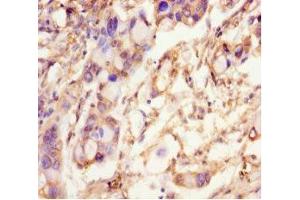 Immunohistochemistry of paraffin-embedded human pancreatic cancer using ABIN7168723 at dilution of 1:100 (SCAMP2 Antikörper  (AA 1-153))