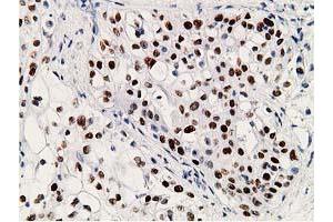 Immunohistochemistry (IHC) image for anti-Tumor Protein P53 (TP53) antibody (ABIN1499968) (p53 Antikörper)