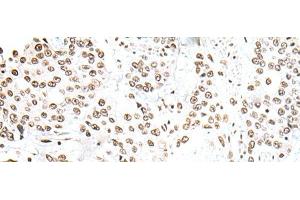 Immunohistochemistry of paraffin-embedded Human prost ate cancer tissue using SNRPA Polyclonal Antibody at dilution of 1:30(x200) (SNRPA1 Antikörper)