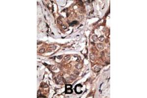 Formalin-fixed and paraffin-embedded human cancer tissue reacted with the HTRA1 polyclonal antibody  , which was peroxidase-conjugated to the secondary antibody, followed by DAB staining.