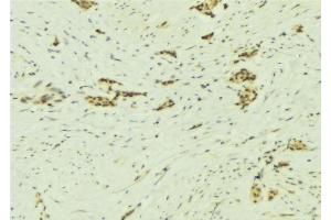 ABIN6277335 at 1/100 staining Human breast cancer tissue by IHC-P. (NAP1L1 Antikörper  (C-Term))