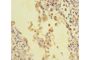 Immunohistochemistry of paraffin-embedded human lung cancer using ABIN7168626 at dilution of 1:100 (STIL Antikörper  (AA 388-637))