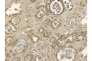 PLCG2 Mouse Monoclonal Antibody at 1/100 staining human ovarian cancer by IHC-P.