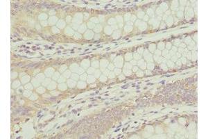 Immunohistochemistry of paraffin-embedded human colon cancer using ABIN7144072 at dilution of 1:100 (ANAPC2 Antikörper  (AA 1-230))