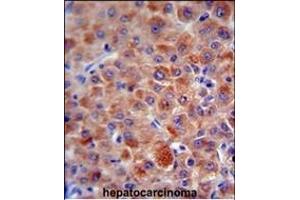 CFH antibody (Center) (ABIN654896 and ABIN2844545) immunohistochemistry analysis in formalin fixed and paraffin embedded human hepatocarcinoma followed by peroxidase conjugation of the secondary antibody and DAB staining.